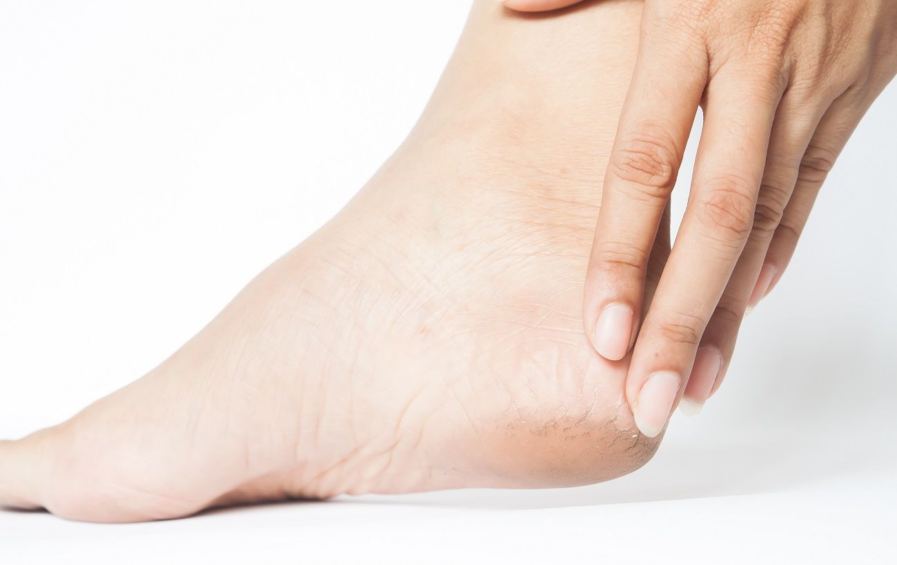 Більше ніяких тріщин: як вилікувати п’яти вдома та не проґавити небезпечний симптом