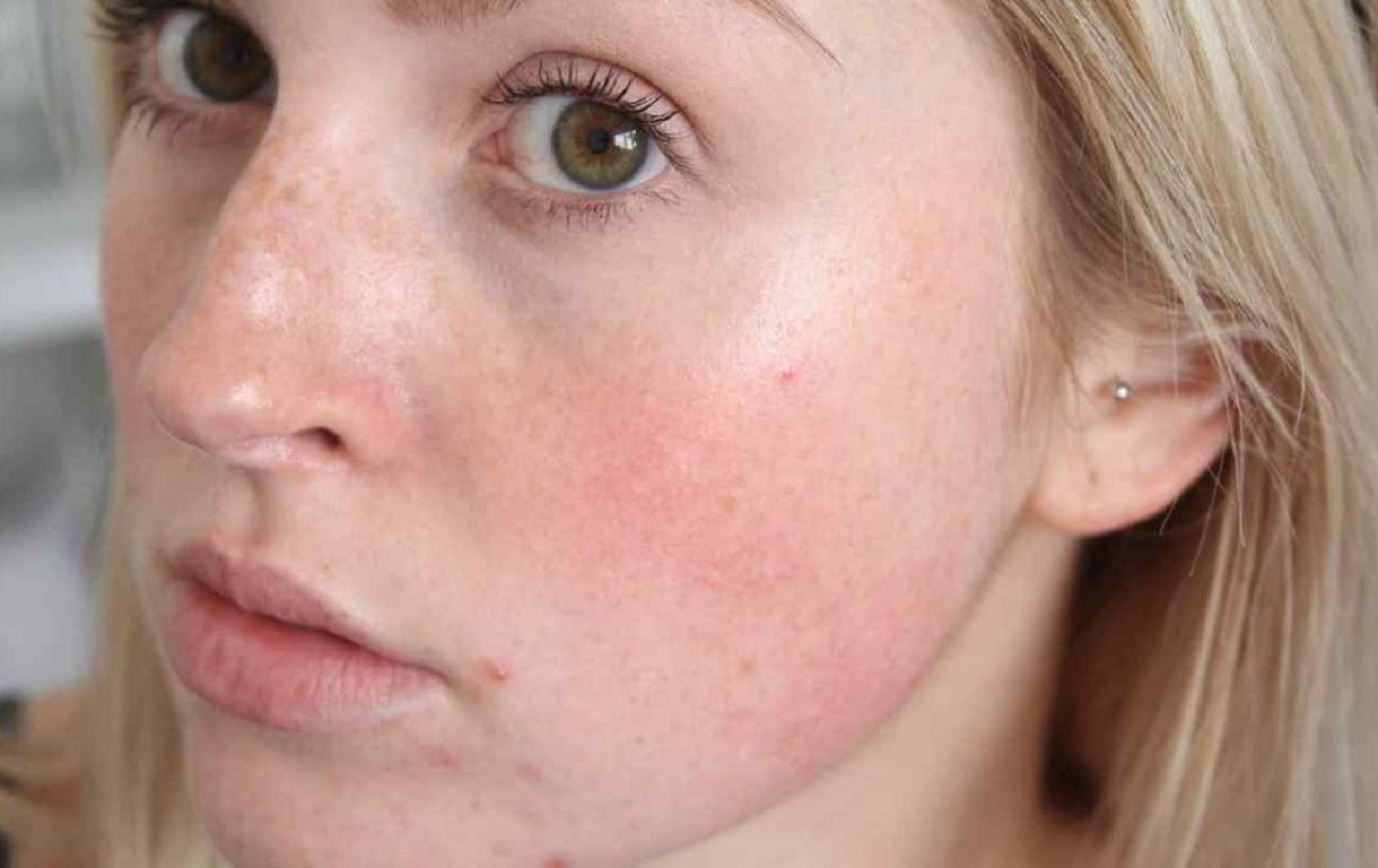 Обличчя раптово червоніє? На це є 6 причин - і це не завжди алергія